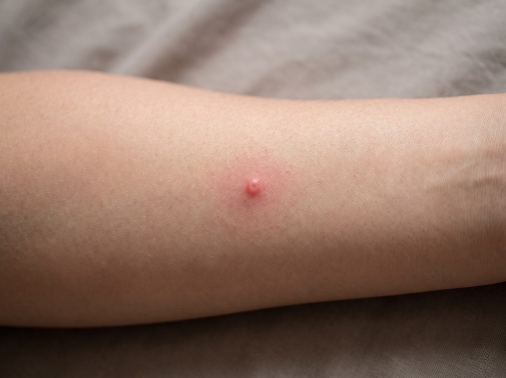 Close-up comparison photo showing a faint superficial skin scratch next to a raised red insect bite with a visible puncture mark